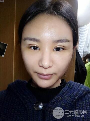 芭比雙眼皮多項整形前后對比照片 青島諾德曹繼武雙眼皮案例