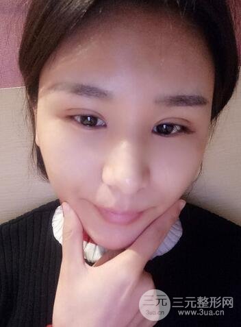 芭比雙眼皮多項整形前后對比照片 青島諾德曹繼武雙眼皮案例