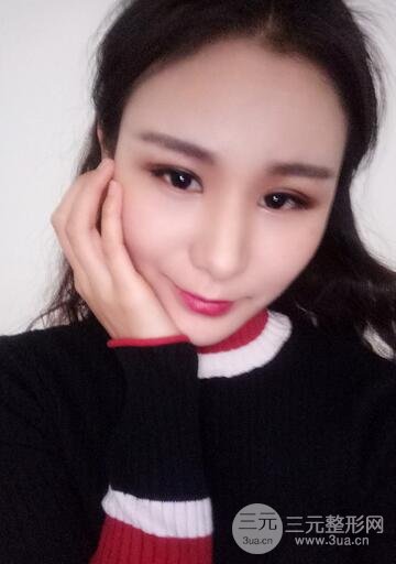 芭比雙眼皮多項整形前后對比照片 青島諾德曹繼武雙眼皮案例