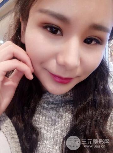 芭比雙眼皮多項整形前后對比照片 青島諾德曹繼武雙眼皮案例