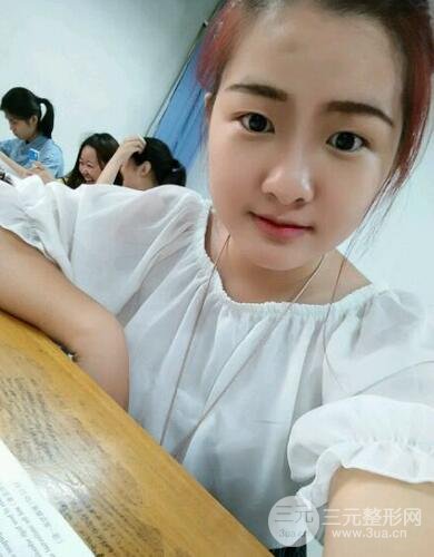 切開雙眼皮開眼角恢復(fù)過程圖 前后果對(duì)比