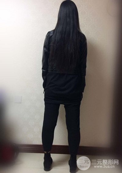 大腿抽脂真實過程圖,輕松擁有細長雙腿