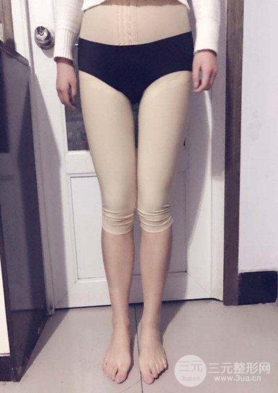 大腿抽脂真實過程圖,輕松擁有細長雙腿