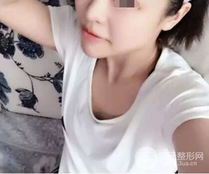 自體脂肪隆胸果超出預(yù)期，擁有**身材不是夢