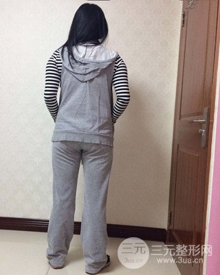 大腿吸脂前后對比照片,南昌永康王忠干真實案例分享