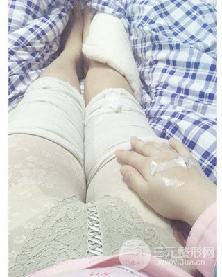 大腿吸脂前后對比照片,南昌永康王忠干真實案例分享