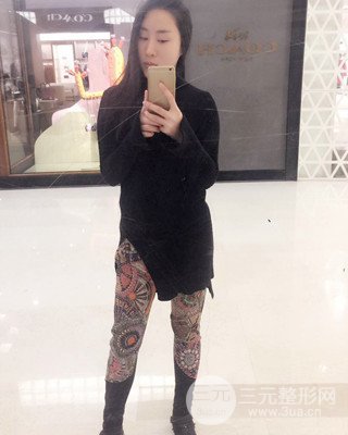 大腿吸脂前后對比照片,南昌永康王忠干真實案例分享