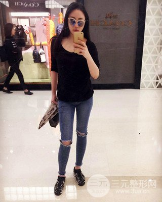 大腿吸脂前后對比照片,南昌永康王忠干真實案例分享