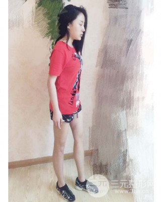 大腿吸脂前后對比照片,南昌永康王忠干真實案例分享