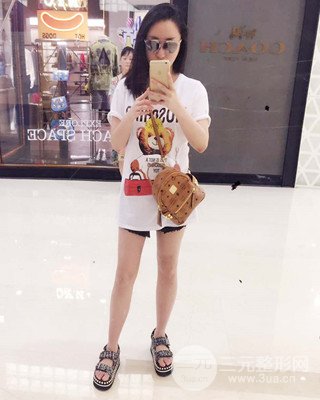 大腿吸脂前后對比照片,南昌永康王忠干真實案例分享