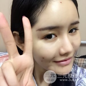 南京米尚恩陳天杰自體脂肪填充全臉 女神的養(yǎng)成記!