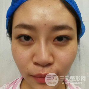 南京克拉美鼻部韓式生科芭比線條修復(fù)