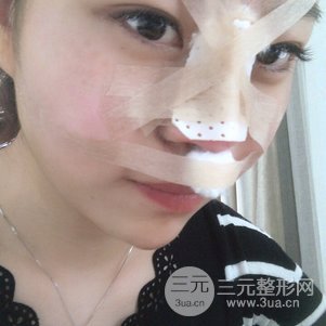 南京克拉美鼻部韓式生科芭比線條修復(fù)