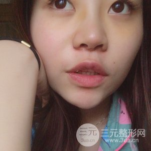 南京克拉美鼻部韓式生科芭比線條修復(fù)