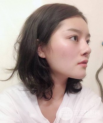 達(dá)拉斯綜合隆鼻后對(duì)比照片，顏值提高不是夢(mèng)