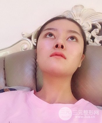 達(dá)拉斯綜合隆鼻后對(duì)比照片，顏值提高不是夢(mèng)