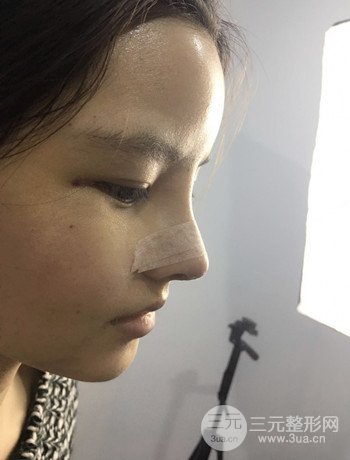 全臉自體脂肪填充+隆鼻整形果永.久保持、丑小鴨變天鵝不是夢(mèng)