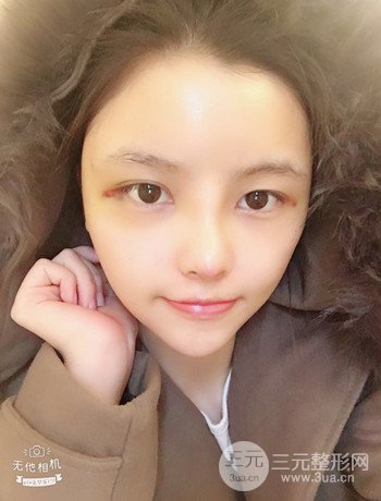 全臉自體脂肪填充+隆鼻整形果永.久保持、丑小鴨變天鵝不是夢(mèng)