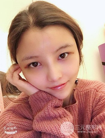 全臉自體脂肪填充+隆鼻整形果永.久保持、丑小鴨變天鵝不是夢(mèng)