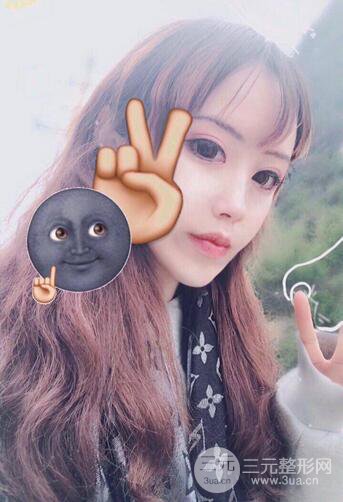 自體脂肪填充全臉基本換臉,改臉型不只是磨骨才能做到!