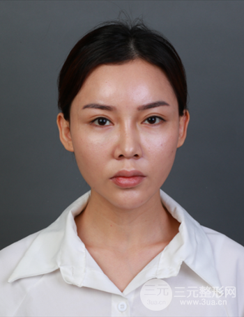 上海隆鼻失敗手術(shù)修復(fù)果超乎想象、前后對比照片分享