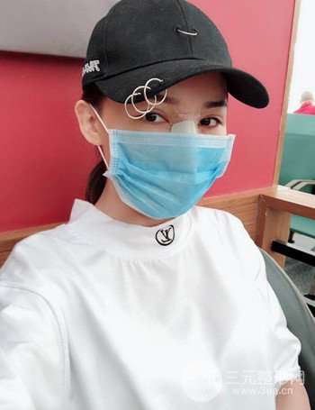 上海隆鼻失敗手術(shù)修復(fù)果超乎想象、前后對比照片分享