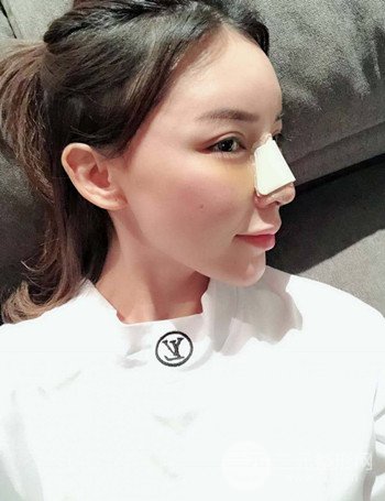 上海隆鼻失敗手術(shù)修復(fù)果超乎想象、前后對比照片分享