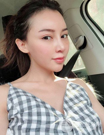 上海隆鼻失敗手術(shù)修復(fù)果超乎想象、前后對比照片分享