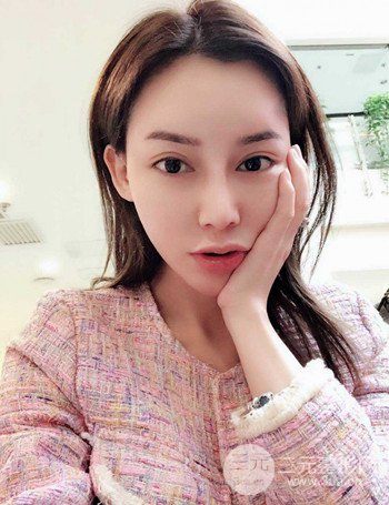 上海隆鼻失敗手術(shù)修復(fù)果超乎想象、前后對比照片分享