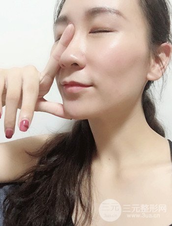 面部埋埋蛋白線.提升改良皮膚松弛，立現(xiàn)小V臉