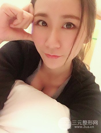 面部埋埋蛋白線.提升改良皮膚松弛，立現(xiàn)小V臉
