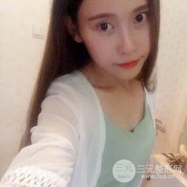 自體脂肪豐胸案例