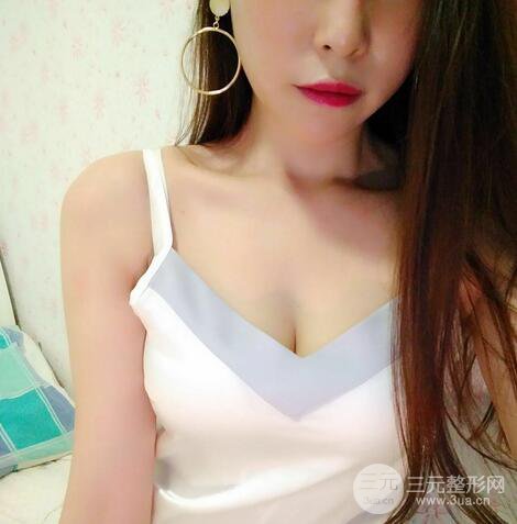 自體脂肪豐胸案例