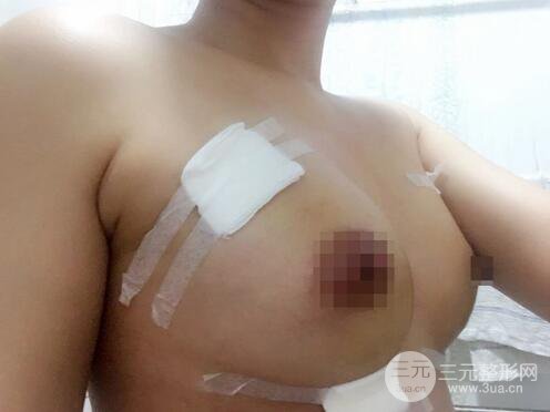 自體脂肪納米豐胸三個(gè)月術(shù)后果展示(附圖)