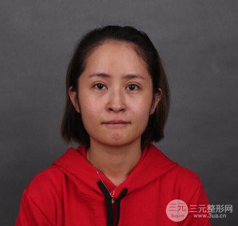 硅膠隆鼻術(shù)前術(shù)后對比照片分享,走上顏值頂峰