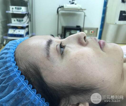 硅膠隆鼻術(shù)前術(shù)后對比照片分享,走上顏值頂峰