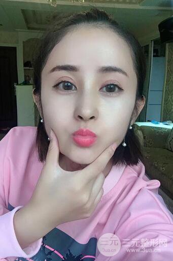 硅膠隆鼻術(shù)前術(shù)后對比照片分享,走上顏值頂峰