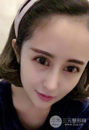 硅膠隆鼻術(shù)前術(shù)后對比照片分享,走上顏值頂峰