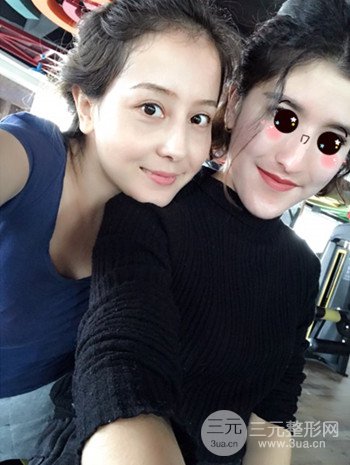 廣州內(nèi)切去眼袋術(shù)后恢復(fù)過程案例對比分享