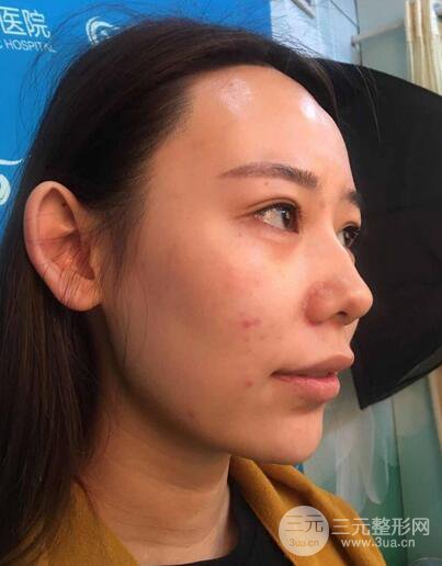 全臉自體脂肪填充，填充不飽滿還可以瘦臉_真人案例