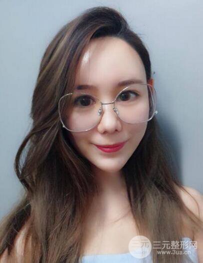 全臉自體脂肪填充，填充不飽滿還可以瘦臉_真人案例