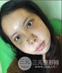 顴骨磨骨改臉型過程和恢復(fù)步驟照片(圖)