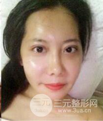 顴骨磨骨改臉型過程和恢復(fù)步驟照片(圖)