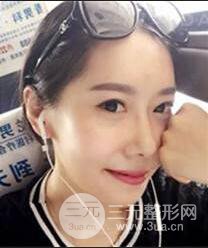 顴骨磨骨改臉型過程和恢復(fù)步驟照片(圖)