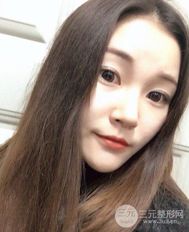 濟(jì)南硅膠假體墊下巴真人案例、下巴改變整個(gè)臉型