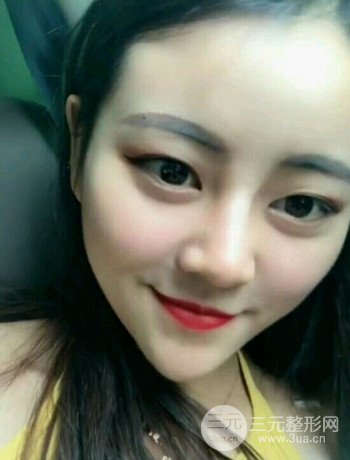 西安切開(kāi)雙眼皮開(kāi)眼角手術(shù)案例恢復(fù)過(guò)程圖分享