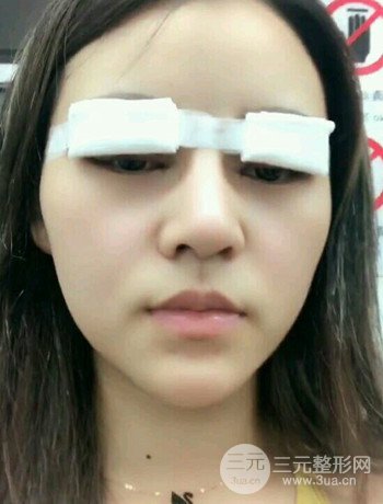 西安切開(kāi)雙眼皮開(kāi)眼角手術(shù)案例恢復(fù)過(guò)程圖分享