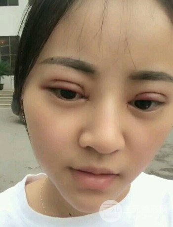 西安切開(kāi)雙眼皮開(kāi)眼角手術(shù)案例恢復(fù)過(guò)程圖分享