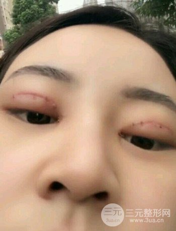 西安切開(kāi)雙眼皮開(kāi)眼角手術(shù)案例恢復(fù)過(guò)程圖分享