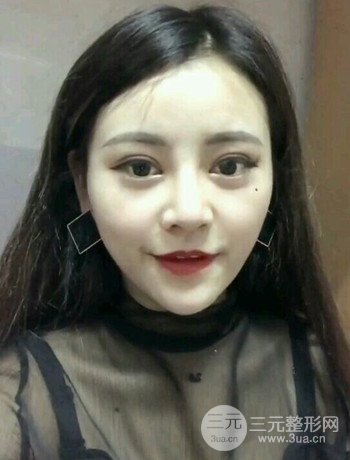 西安切開(kāi)雙眼皮開(kāi)眼角手術(shù)案例恢復(fù)過(guò)程圖分享